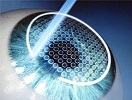 Femto LASIK