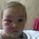 опух очей що робити