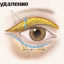удаление грыжи век