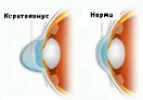Кератоконус глаза