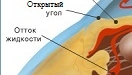 Открытоугольная глаукома