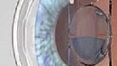 Новая интраокулярная линза поможет в борьбе с глаукомой