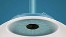 Операція Епі-ЛАСІК (Epi LASIK)